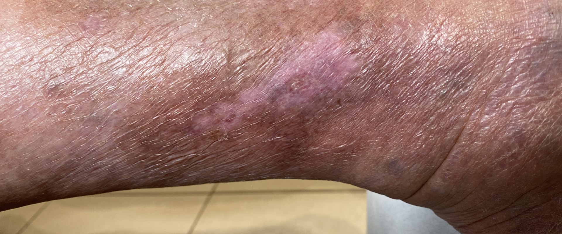 Exploring the Impact of Skin Ulcer Symptoms on Daily Life
