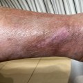Exploring the Impact of Skin Ulcer Symptoms on Daily Life